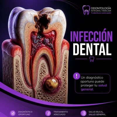 infeccion dental